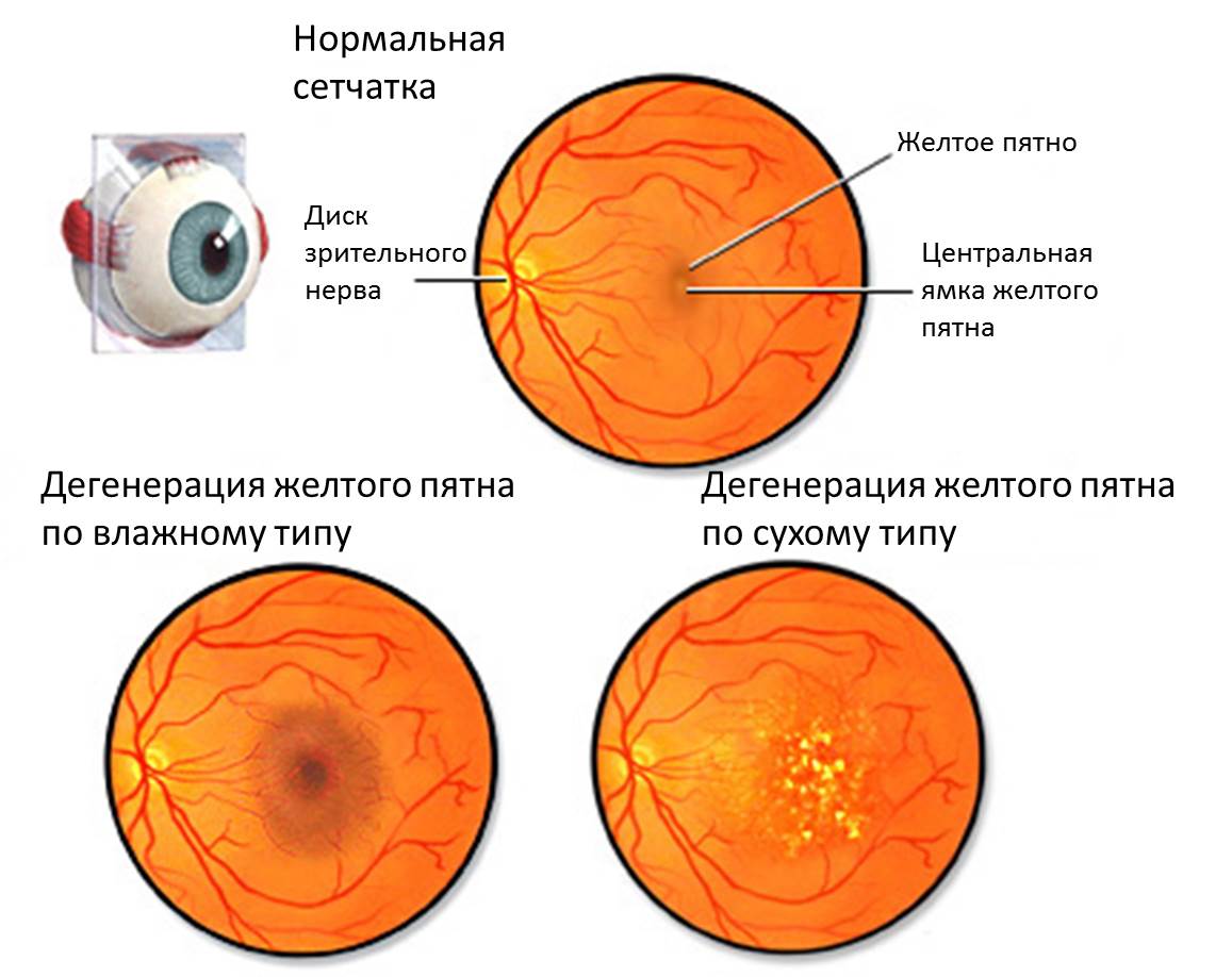 Дегенерация желтого пятна глаза лечение