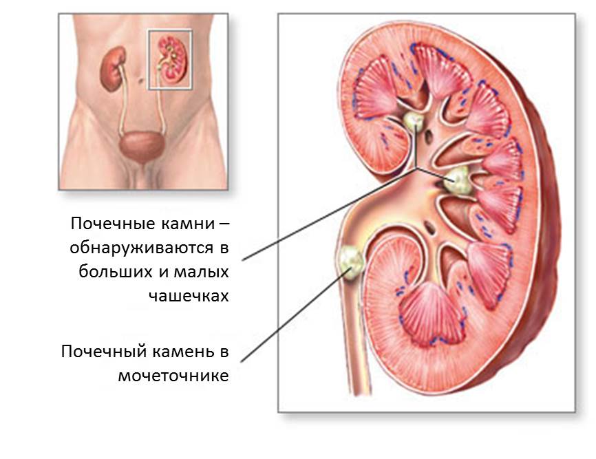 Почечные Камни Фото