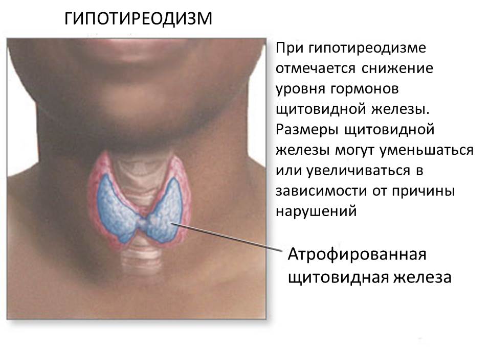 Consecuencias del hipotiroidismo