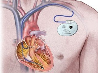 http://static.medportal.ru/pic/news/2012/02/16/pacemaker/pic001.jpg