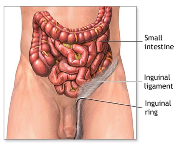 What Is an Inguinal Hernia? - StoryMD