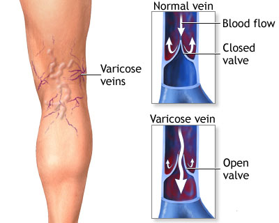 Varicose Vein Treatment: Which Approach Is Best for You? - University Health News