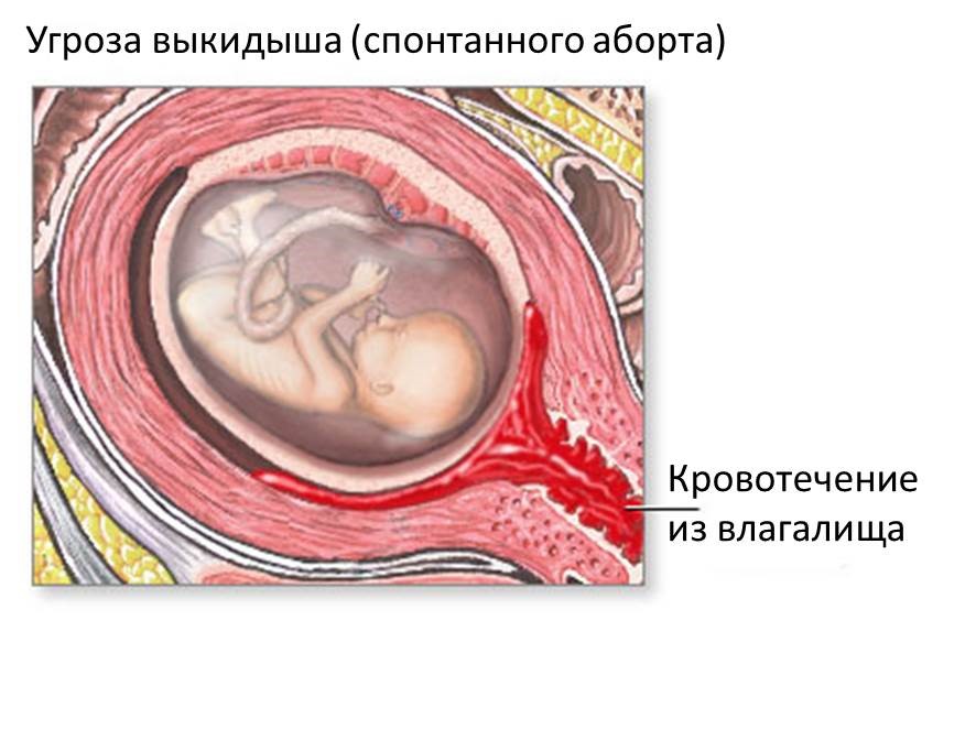 6 Недель Беременности Выкидыш Фото