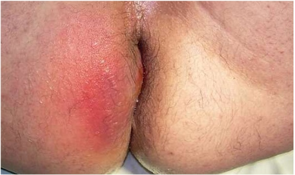 https://www.zdrav.kz/images/refs3/anabscess.PNG