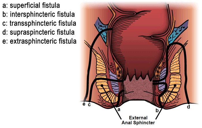 Kinds of fistulas diagram