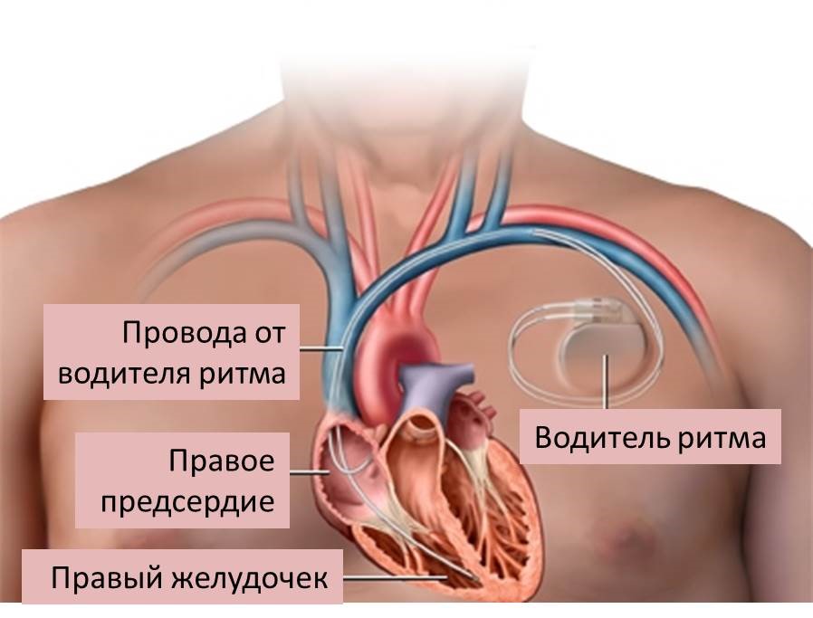 При наличии кардиостимулятора можно. Водители ритма сердца. Искусственный водитель ритма. Двухкамерный кардиостимулятор. Искусственный водитель ритма сердца.