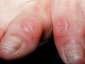 Picture of Callus on the finger and palm in a male. Calloses develop wherever the skin is exposed repeatedly to pressure or friction, as…