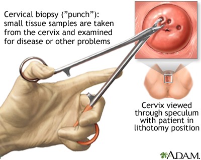 Cervical biopsy