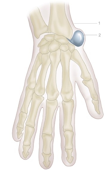 http://www.nhs.uk/Conditions/excisionofganglion/PublishingImages/30.%20Ganglion(A).jpg