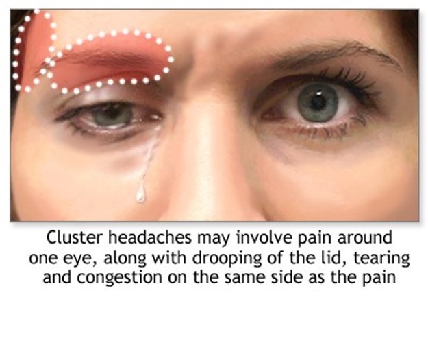 ain of cluster headache