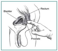Description: Cross section of a digital rectal exam. A health care provider’s gloved index finger is inserted into the rectum to feel the size and shape of the prostate.