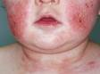 This image displays scaling, dry, slightly elevated lesions typical of atopic dermatitis (eczema).