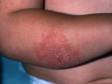 This image displays symmetric scaling, red, slightly elevated lesions typical of atopic dermatitis (eczema).