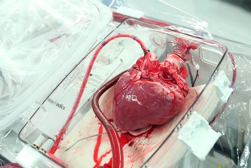 Операция по пересадке сердца