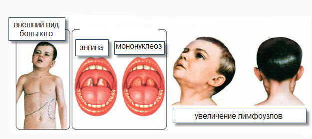 Инфекционный мононуклеоз